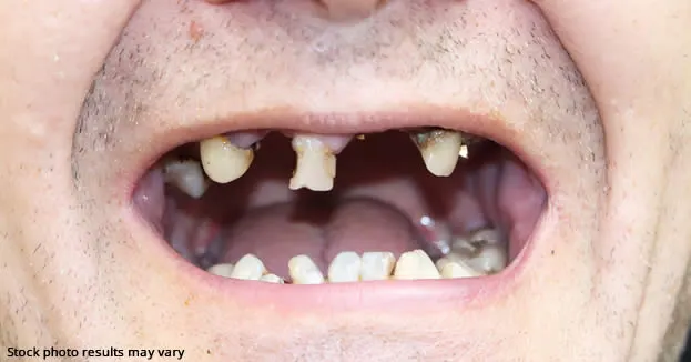 Full mouth restoration in Taylor
