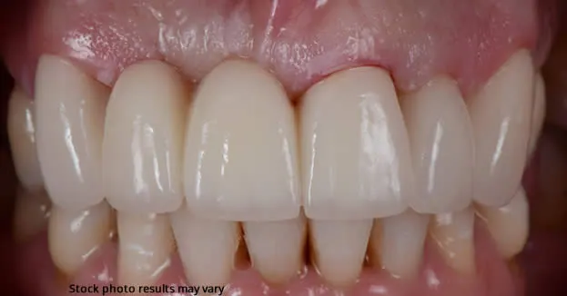 After dental bridge placement