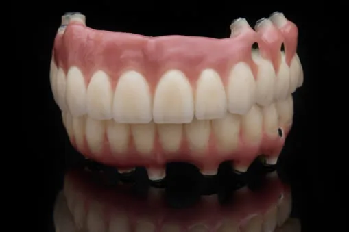 Full mouth dental implants