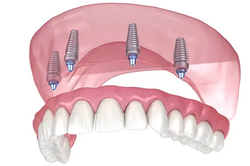 All-on-4 dental implants in Taylor
