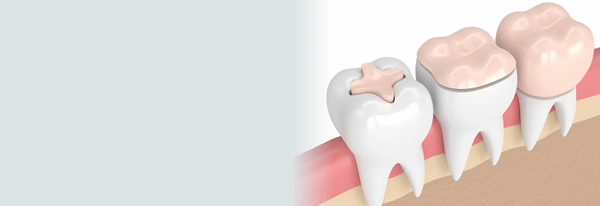 Dental inlays and onlays in Taylor