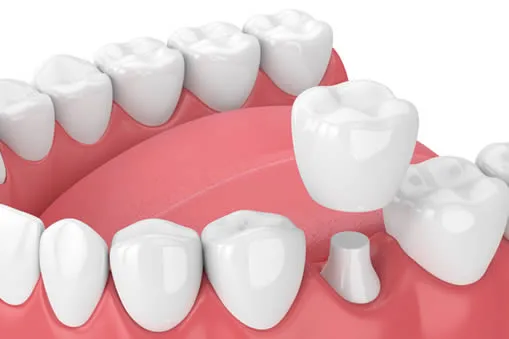 Dental crowns and bridges in Taylor